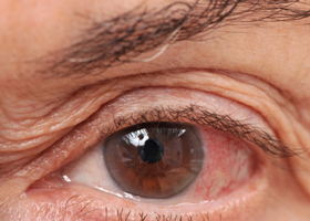 Glaucoma: Factores de Riesgo